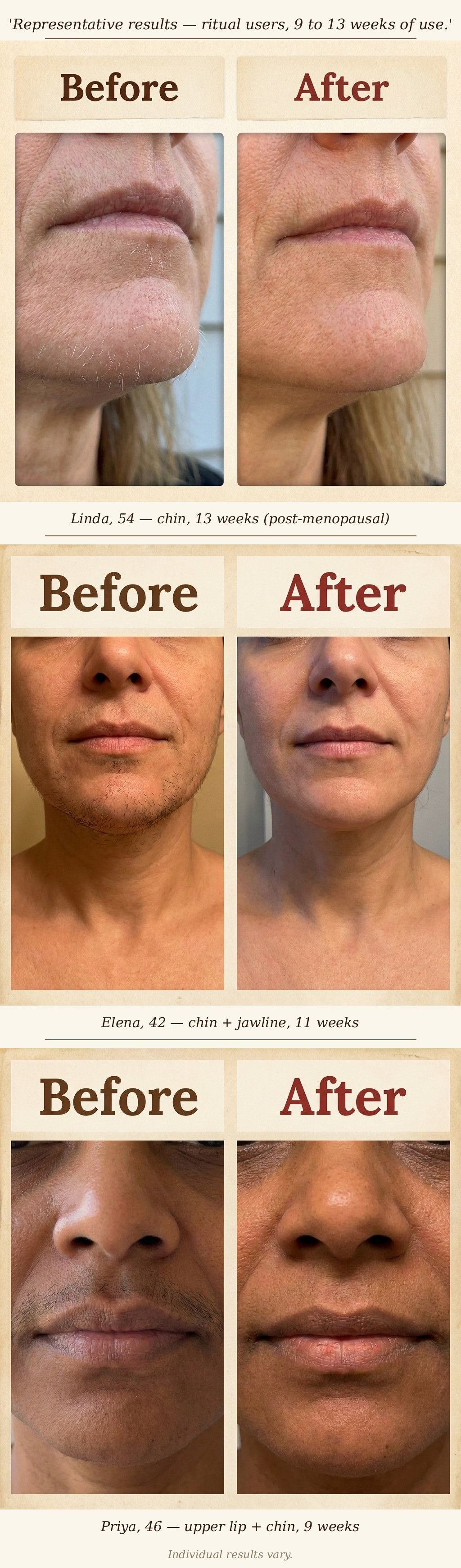 Three before and after photo pairs showing chin and upper lip hair removal results after 9 to 13 weeks